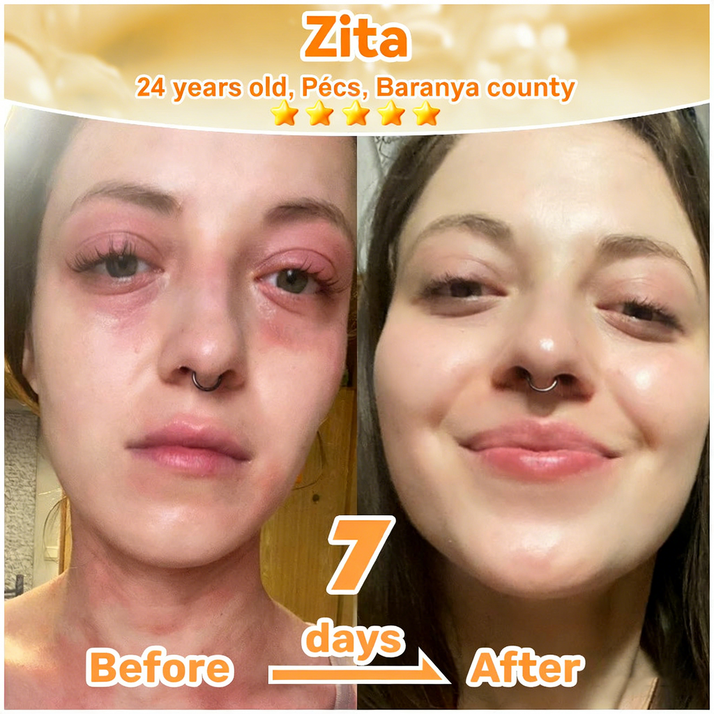 𝐋𝐎𝐕𝐈𝐋𝐃𝐒™ 𝐁𝐞𝐞 𝐏𝐨𝐢𝐬𝐨𝐧 𝐀𝐥𝐥-𝐢𝐧-𝐎𝐧𝐞 𝐂𝐫𝐞𝐚𝐦–🌸 Anti-aging,Hydrating, Skin Repair, Even Tone, Acne and Dark Spot Treatment, Wart and Mole Removal, Psoriasis Relief