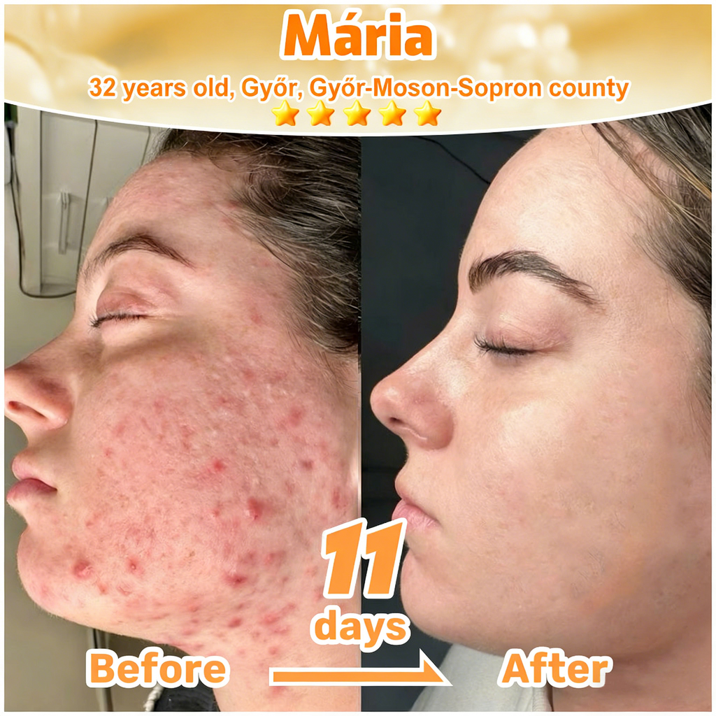 𝐋𝐎𝐕𝐈𝐋𝐃𝐒™ 𝐁𝐞𝐞 𝐏𝐨𝐢𝐬𝐨𝐧 𝐀𝐥𝐥-𝐢𝐧-𝐎𝐧𝐞 𝐂𝐫𝐞𝐚𝐦–🌸 Anti-aging,Hydrating, Skin Repair, Even Tone, Acne and Dark Spot Treatment, Wart and Mole Removal, Psoriasis Relief