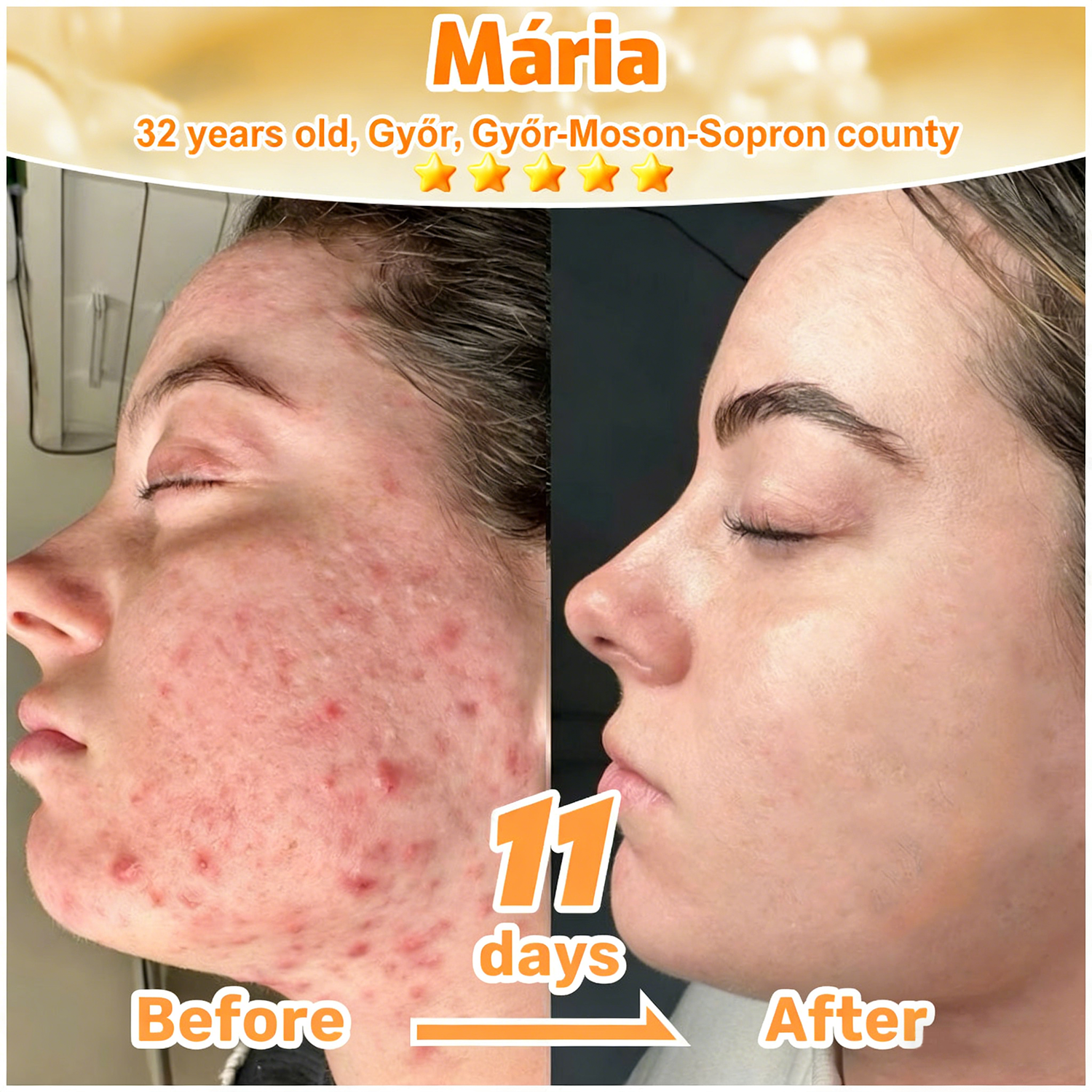 𝐋𝐎𝐕𝐈𝐋𝐃𝐒™ 𝐁𝐞𝐞 𝐏𝐨𝐢𝐬𝐨𝐧 𝐀𝐥𝐥-𝐢𝐧-𝐎𝐧𝐞 𝐂𝐫𝐞𝐚𝐦–🌸 Anti-aging,Hydrating, Skin Repair, Even Tone, Acne and Dark Spot Treatment, Wart and Mole Removal, Psoriasis Relief