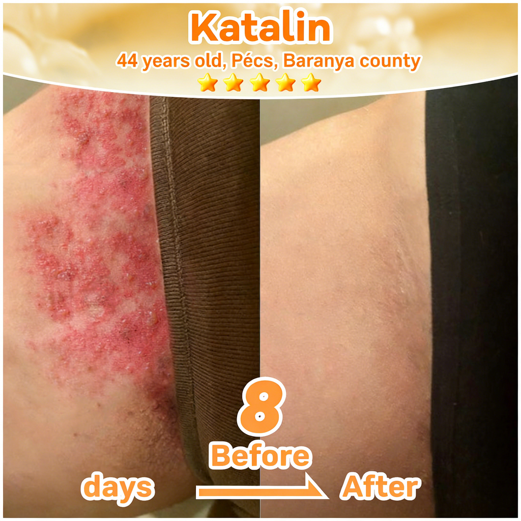 𝐋𝐎𝐕𝐈𝐋𝐃𝐒™ 𝐁𝐞𝐞 𝐏𝐨𝐢𝐬𝐨𝐧 𝐀𝐥𝐥-𝐢𝐧-𝐎𝐧𝐞 𝐂𝐫𝐞𝐚𝐦–🌸 Anti-aging,Hydrating, Skin Repair, Even Tone, Acne and Dark Spot Treatment, Wart and Mole Removal, Psoriasis Relief