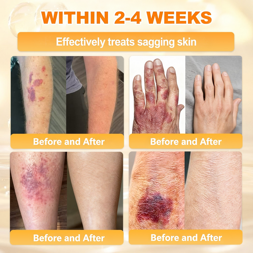𝐋𝐎𝐕𝐈𝐋𝐃𝐒™ 𝐁𝐞𝐞 𝐏𝐨𝐢𝐬𝐨𝐧 𝐀𝐥𝐥-𝐢𝐧-𝐎𝐧𝐞 𝐂𝐫𝐞𝐚𝐦–🌸 Anti-aging,Hydrating, Skin Repair, Even Tone, Acne and Dark Spot Treatment, Wart and Mole Removal, Psoriasis Relief