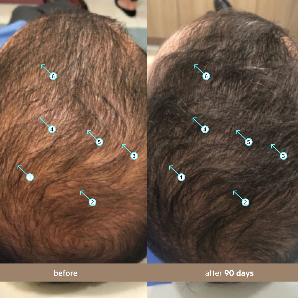 Spectral Men’s Nanoxidil 5% Hair Growth Serum for Thicker, Fuller Hair
