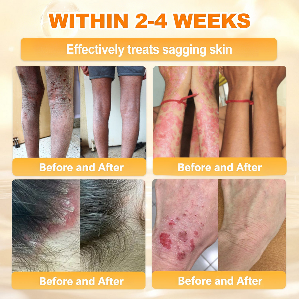 𝐋𝐎𝐕𝐈𝐋𝐃𝐒™ 𝐁𝐞𝐞 𝐏𝐨𝐢𝐬𝐨𝐧 𝐀𝐥𝐥-𝐢𝐧-𝐎𝐧𝐞 𝐂𝐫𝐞𝐚𝐦–🌸 Anti-aging,Hydrating, Skin Repair, Even Tone, Acne and Dark Spot Treatment, Wart and Mole Removal, Psoriasis Relief