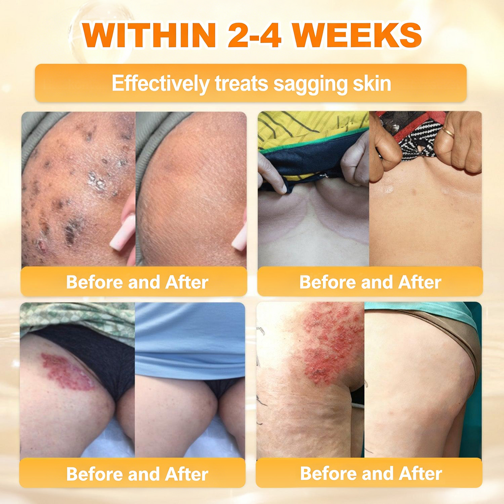 𝐋𝐎𝐕𝐈𝐋𝐃𝐒™ 𝐁𝐞𝐞 𝐏𝐨𝐢𝐬𝐨𝐧 𝐀𝐥𝐥-𝐢𝐧-𝐎𝐧𝐞 𝐂𝐫𝐞𝐚𝐦–🌸 Anti-aging,Hydrating, Skin Repair, Even Tone, Acne and Dark Spot Treatment, Wart and Mole Removal, Psoriasis Relief
