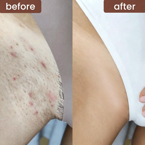 3-in-1 Bikini Line Care Serum