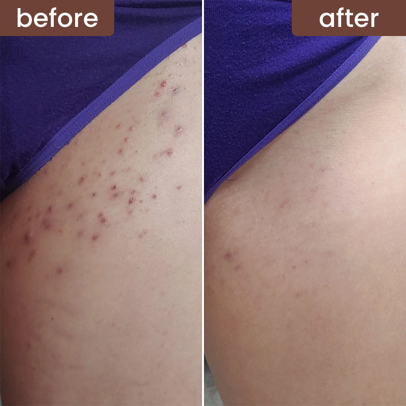 3-in-1 Bikini Line Care Serum